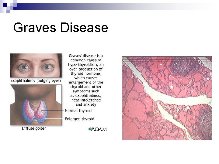 Graves Disease 