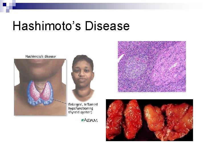 Hashimoto’s Disease 
