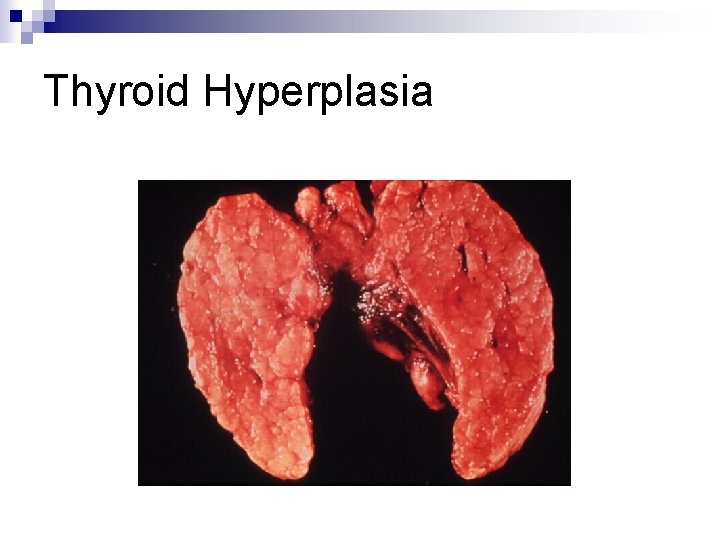 Thyroid Hyperplasia 