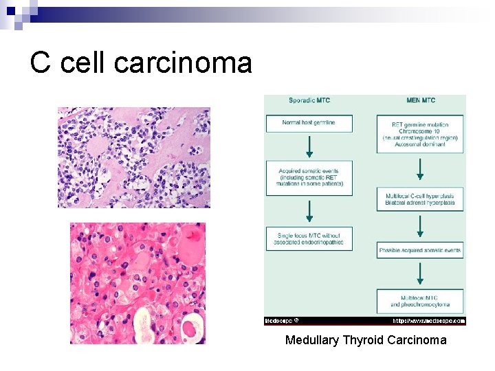 C cell carcinoma Medullary Thyroid Carcinoma 