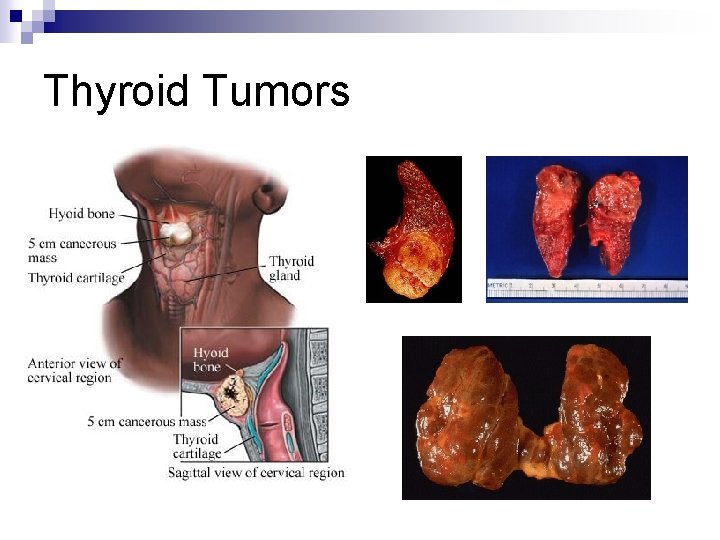 Thyroid Tumors 