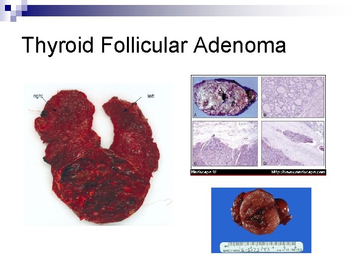 Thyroid Follicular Adenoma 