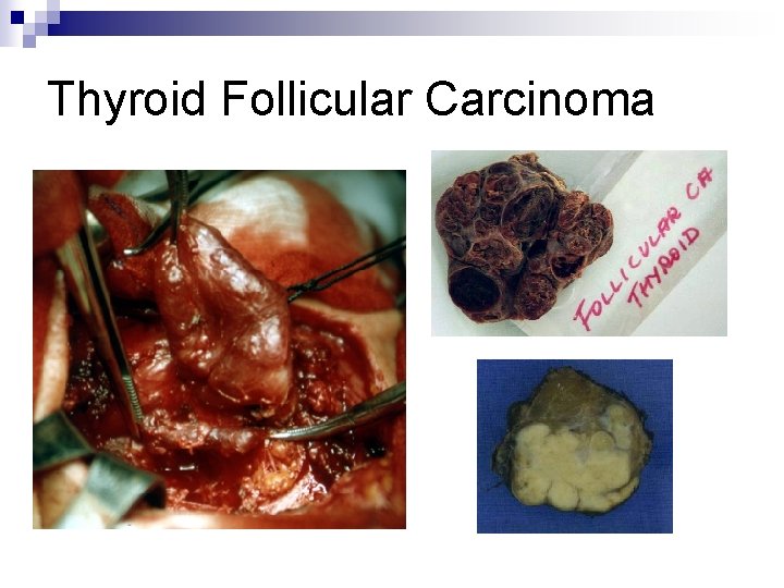 Thyroid Follicular Carcinoma 