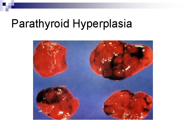 Parathyroid Hyperplasia 