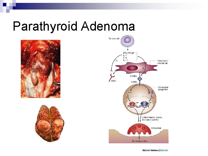 Parathyroid Adenoma 