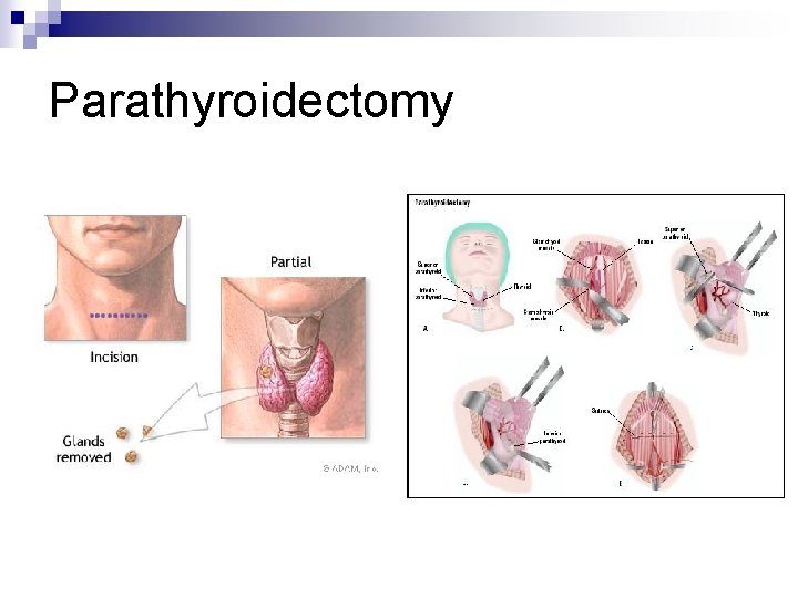 Parathyroidectomy 