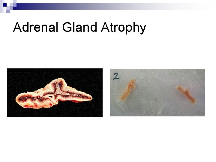 Adrenal Gland Atrophy 