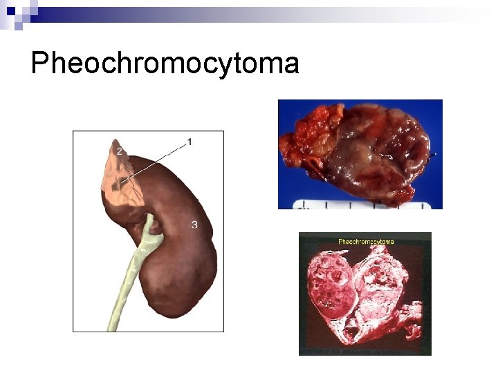 Pheochromocytoma 