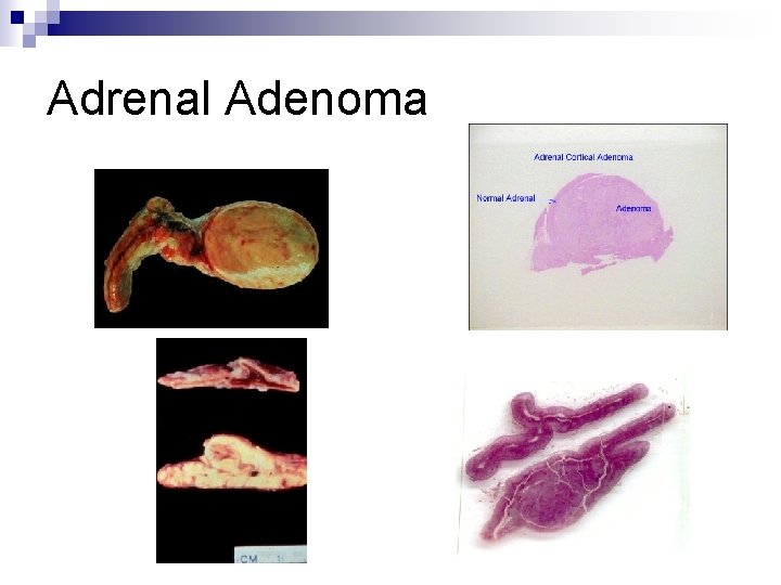 Adrenal Adenoma 