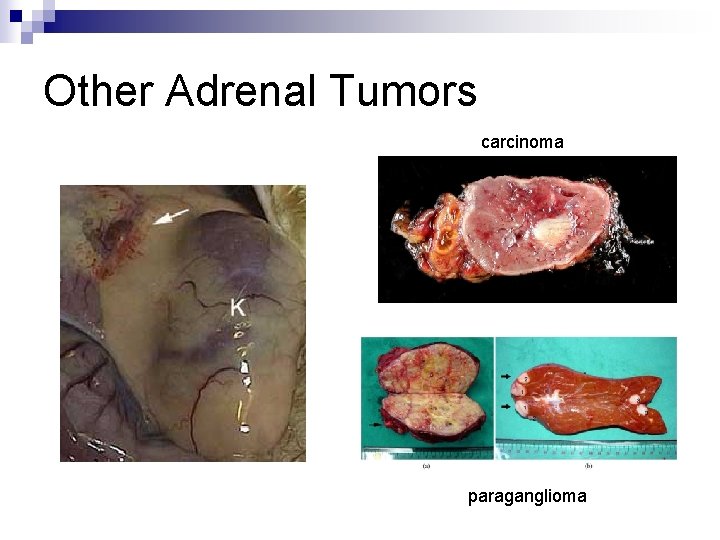 Other Adrenal Tumors carcinoma paraganglioma 