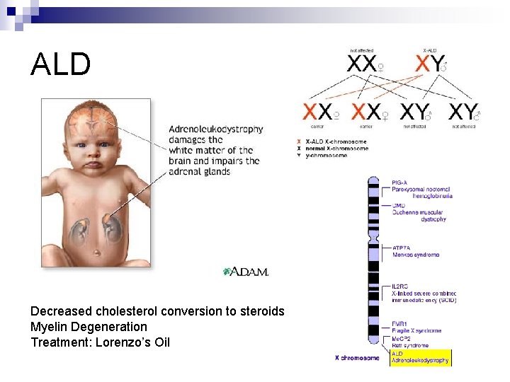 ALD Decreased cholesterol conversion to steroids Myelin Degeneration Treatment: Lorenzo’s Oil 