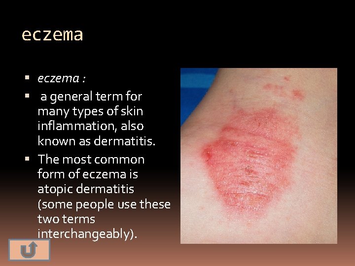 eczema : a general term for many types of skin inflammation, also known as