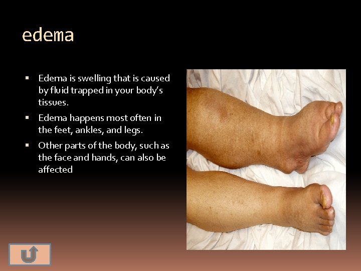 edema Edema is swelling that is caused by fluid trapped in your body’s tissues.