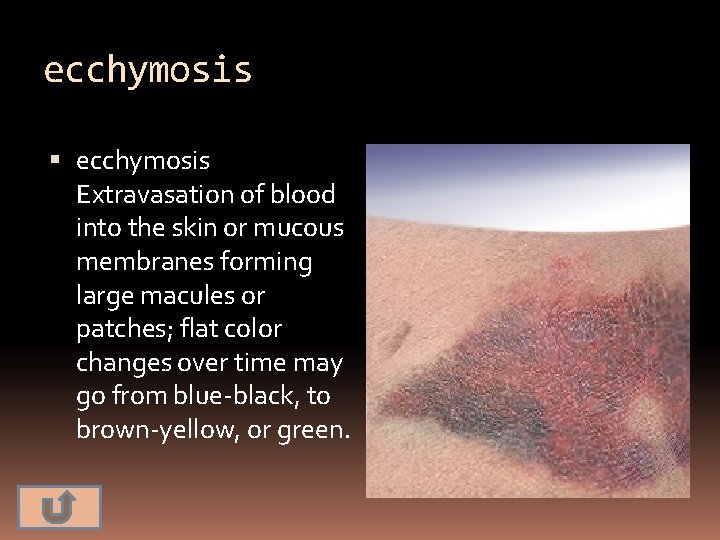 ecchymosis Extravasation of blood into the skin or mucous membranes forming large macules or