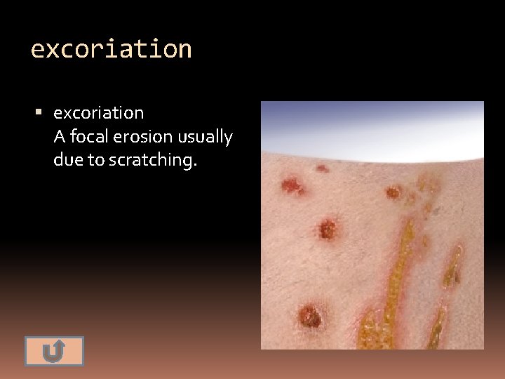 excoriation A focal erosion usually due to scratching. 