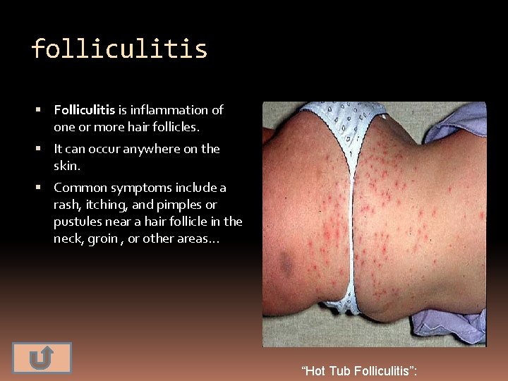 folliculitis Folliculitis is inflammation of one or more hair follicles. It can occur anywhere