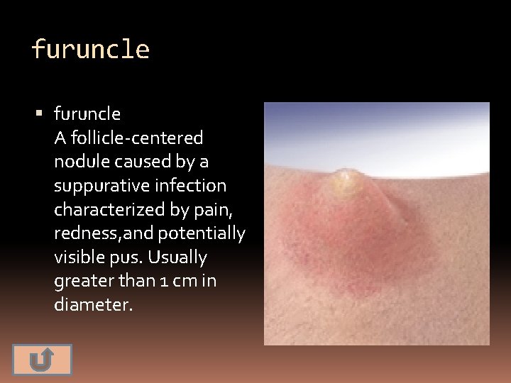 furuncle A follicle-centered nodule caused by a suppurative infection characterized by pain, redness, and