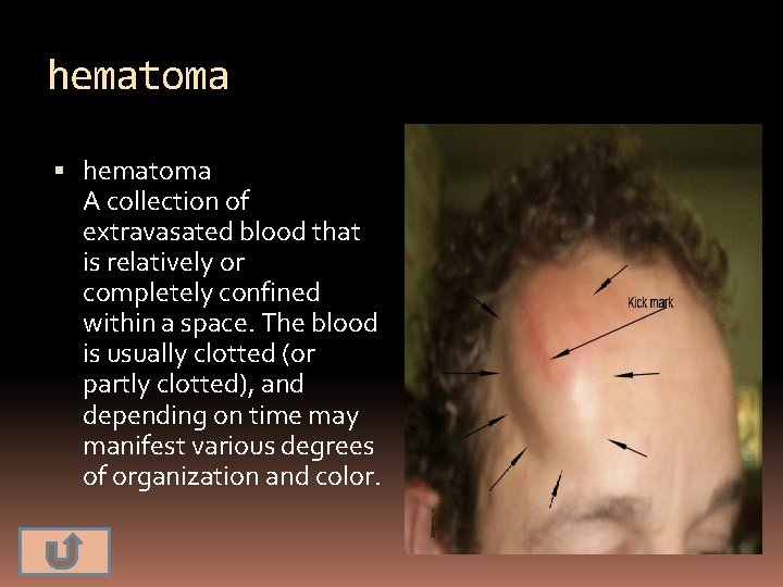 hematoma A collection of extravasated blood that is relatively or completely confined within a