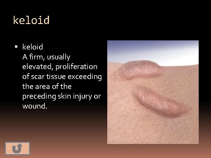 keloid A firm, usually elevated, proliferation of scar tissue exceeding the area of the