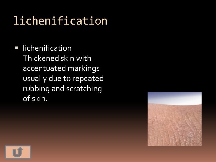 lichenification Thickened skin with accentuated markings usually due to repeated rubbing and scratching of