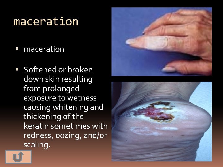 maceration Softened or broken down skin resulting from prolonged exposure to wetness causing whitening