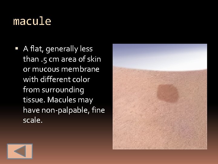 macule A flat, generally less than. 5 cm area of skin or mucous membrane