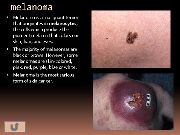 melanoma Melanoma is a malignant tumor that originates in melanocytes, the cells which produce