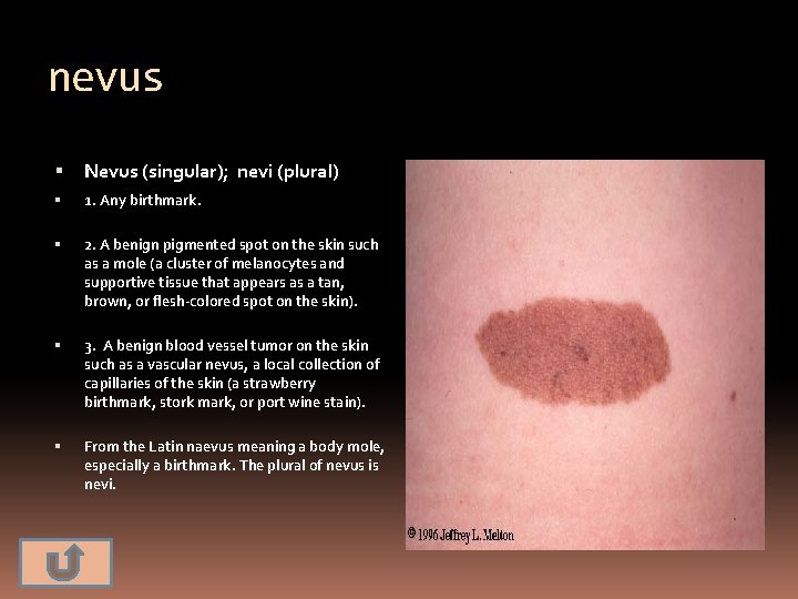 nevus Nevus (singular); nevi (plural) 1. Any birthmark. 2. A benign pigmented spot on