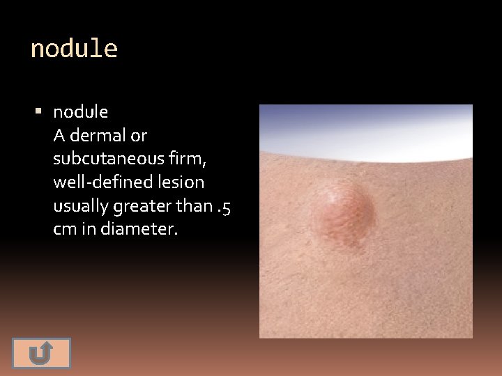 nodule A dermal or subcutaneous firm, well-defined lesion usually greater than. 5 cm in