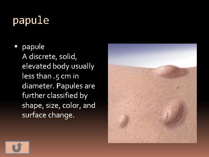 papule A discrete, solid, elevated body usually less than. 5 cm in diameter. Papules