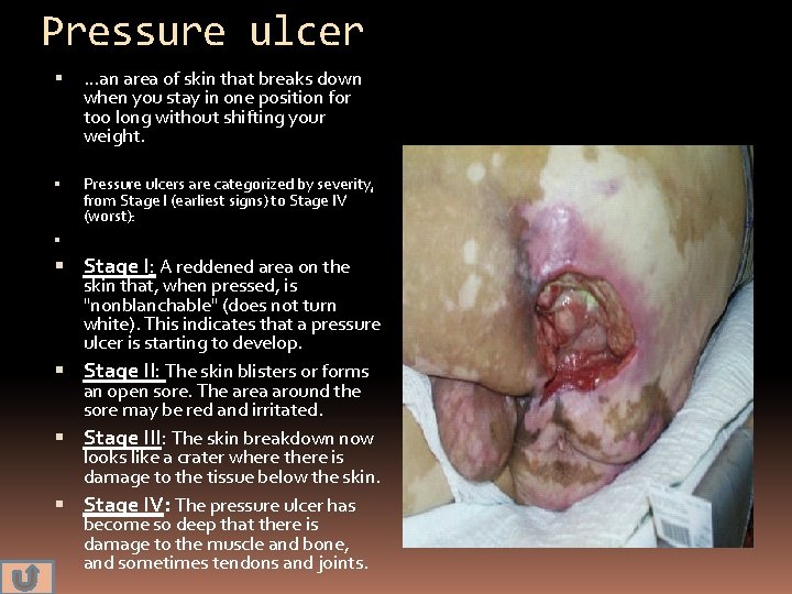 Pressure ulcer …an area of skin that breaks down when you stay in one