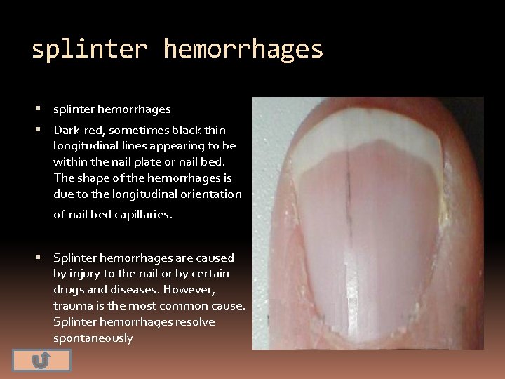 splinter hemorrhages Dark-red, sometimes black thin longitudinal lines appearing to be within the nail