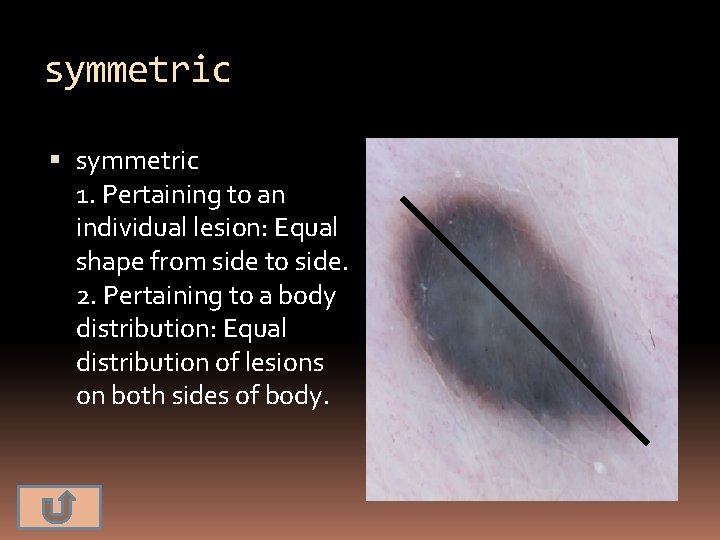 symmetric 1. Pertaining to an individual lesion: Equal shape from side to side. 2.