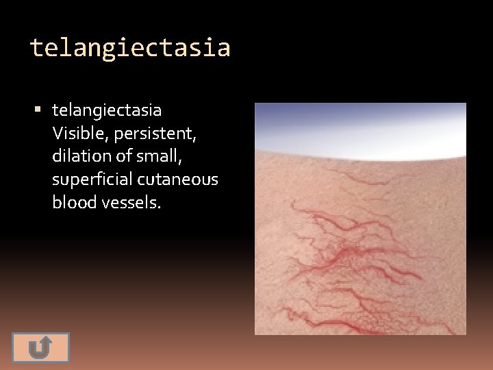 telangiectasia Visible, persistent, dilation of small, superficial cutaneous blood vessels. 