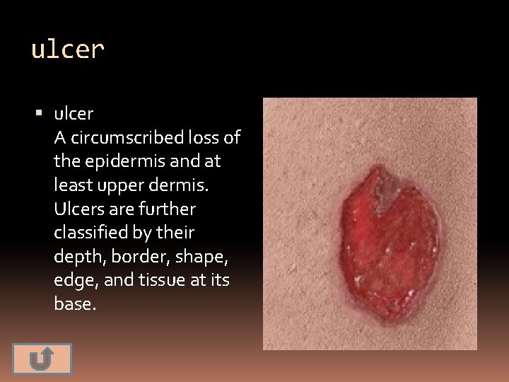 ulcer A circumscribed loss of the epidermis and at least upper dermis. Ulcers are