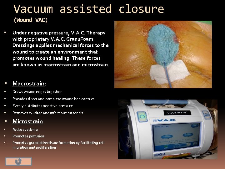 Vacuum assisted closure (Wound VAC) Under negative pressure, V. A. C. Therapy with proprietary