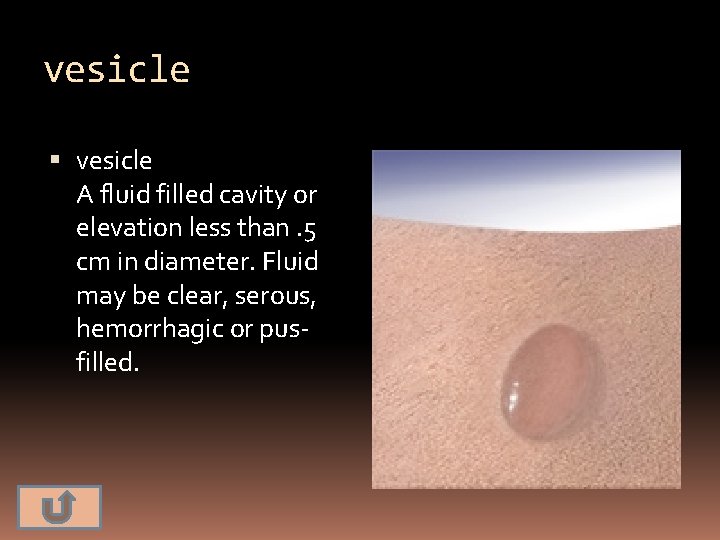 vesicle A fluid filled cavity or elevation less than. 5 cm in diameter. Fluid