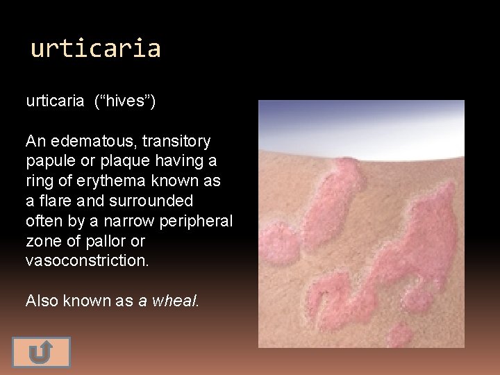 urticaria (“hives”) An edematous, transitory papule or plaque having a ring of erythema known