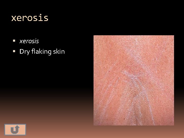 xerosis Dry flaking skin 