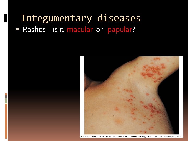 Integumentary diseases Rashes – is it macular or papular? 