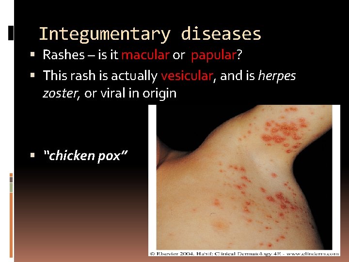 Integumentary diseases Rashes – is it macular or papular? This rash is actually vesicular,