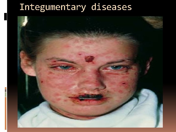 Integumentary diseases 