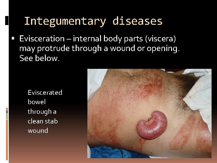 Integumentary diseases Evisceration – internal body parts (viscera) may protrude through a wound or