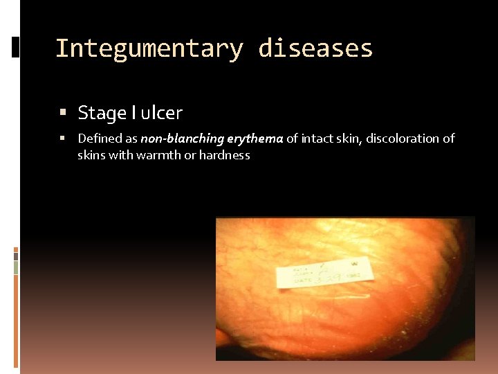 Integumentary diseases Stage I ulcer Defined as non-blanching erythema of intact skin, discoloration of