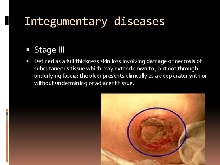 Integumentary diseases Stage III Defined as a full thickness skin loss involving damage or