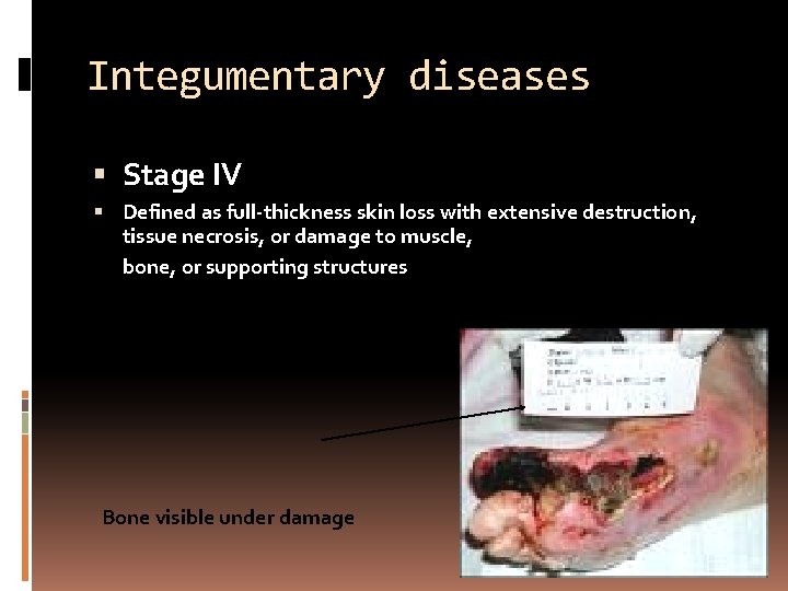 Integumentary diseases Stage IV Defined as full-thickness skin loss with extensive destruction, tissue necrosis,