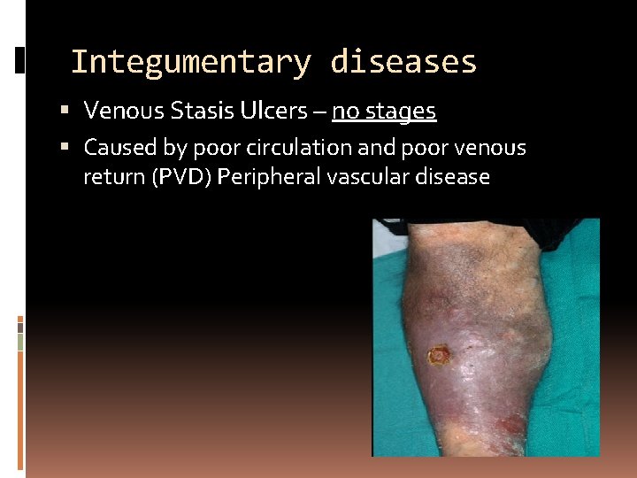 Integumentary diseases Venous Stasis Ulcers – no stages Caused by poor circulation and poor