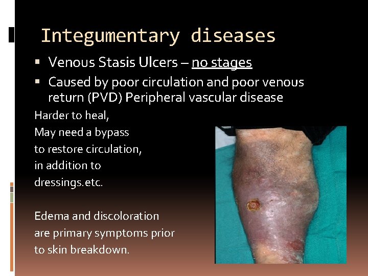 Integumentary diseases Venous Stasis Ulcers – no stages Caused by poor circulation and poor