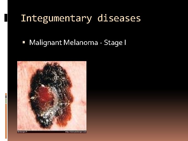 Integumentary diseases Malignant Melanoma - Stage I 