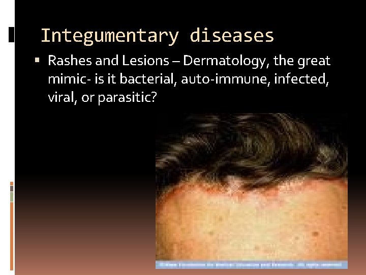 Integumentary diseases Rashes and Lesions – Dermatology, the great mimic- is it bacterial, auto-immune,